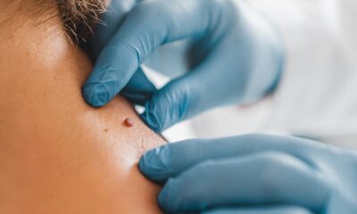 Skin Tag Removal