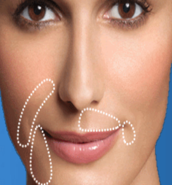 Restylane filler and mole remover