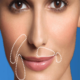 Restylane filler and mole remover