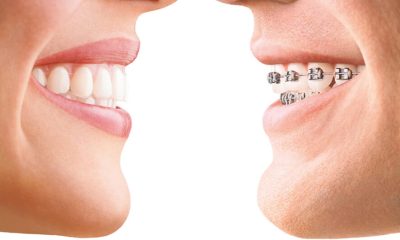 Braces or Clear Aligners