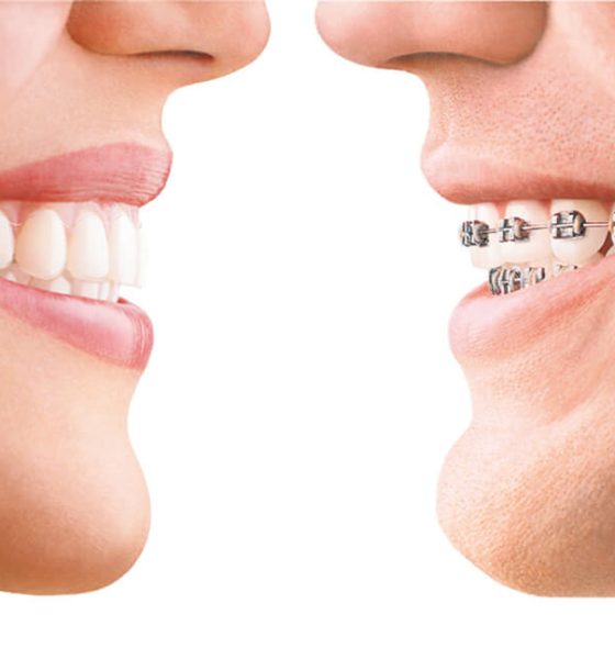 Braces or Clear Aligners